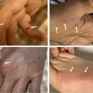 Skin and joint lesions. (A) Osler nodes. (B) Janeway lesions. (C ...