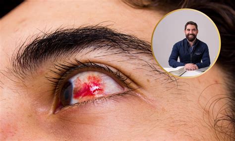 saiba por   derrame ocular aparece de repente  quando merece atencao