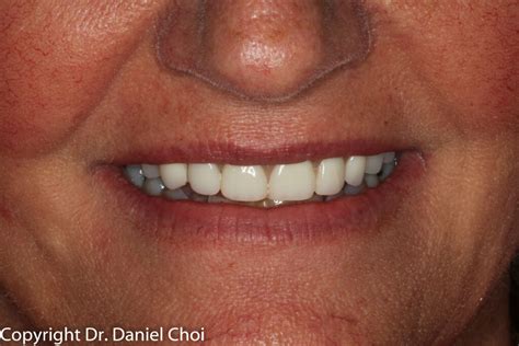 Snap-In Dentures - North Texas Dental Surgery