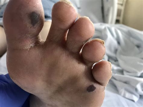 Janeway Lesions Feet Infective Endocarditis ScienceDirect