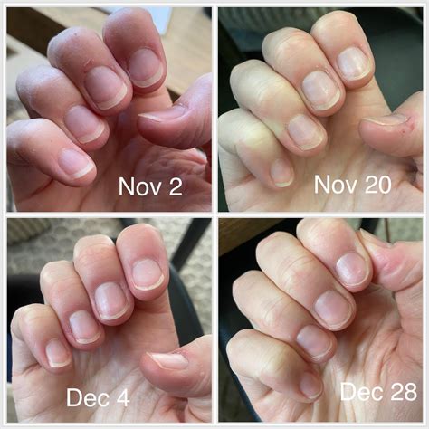 Nail Bed Progress - 2 Months : r/nailbiting