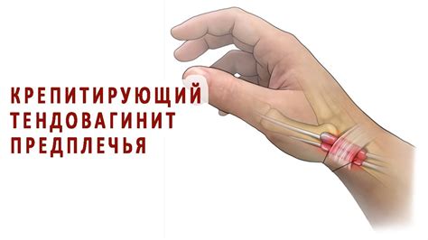 Крепитирующий тендовагинит предплечья - YouTube