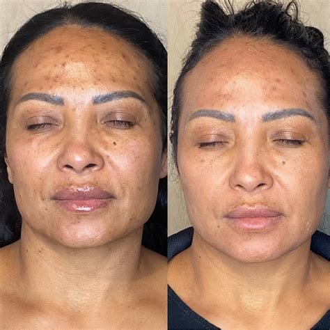Acne Facial Treatment Benefits at Hugo Jenyns blog