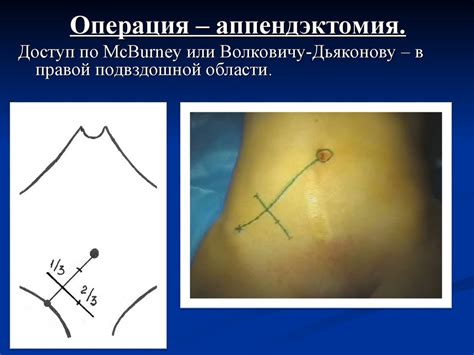 Острый аппендицит - презентация онлайн