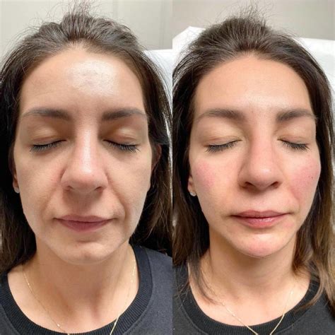 Контурная пластика лица — мгновенный видимый эффект омоложения — VG CLINIC