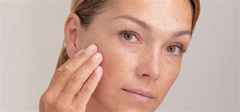 brown spots treatment wellesley ma md tlc