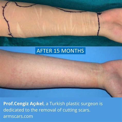 Self-Harm Scars - Laser Removal - Dr Davin Lim