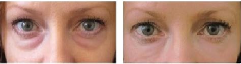 Dermaheal Eyebag Solution | GetGlowing Skincare