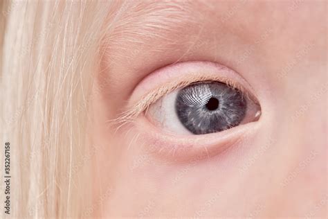 close-up mystic photo of albino child eye, kid girl with unusual eyes ...