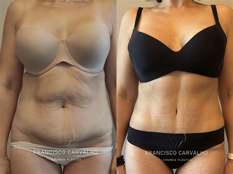 Fotos Do Antes E Depois Da Abdominoplastia - Abdominoplastia Antes e Depois