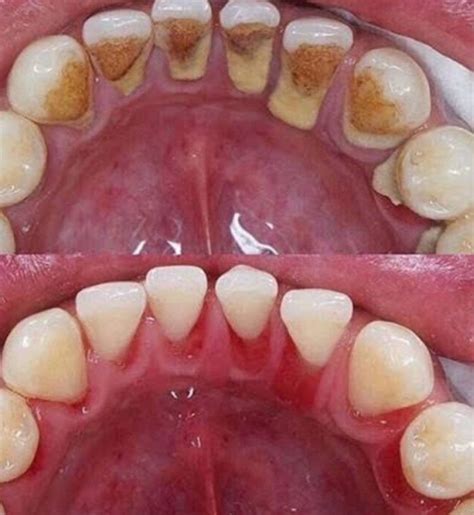 Raspagem Antes E Depois