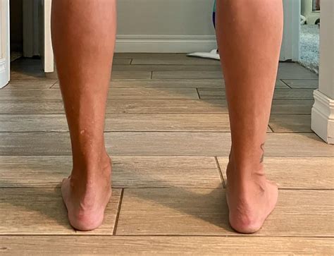 Pes Planus, Planter Fasciitis and MH results : VeteransBenefits