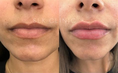 4 Types of Lip Filler: Which Lip Filler Is Best for You?