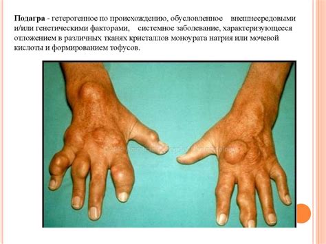 Лечение подагры - презентация онлайн
