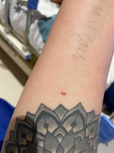 Unidentified hard lump since 2016 : r/Melanoma