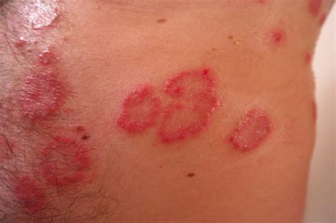 surviving  severe allergic reaction pharmacy itk