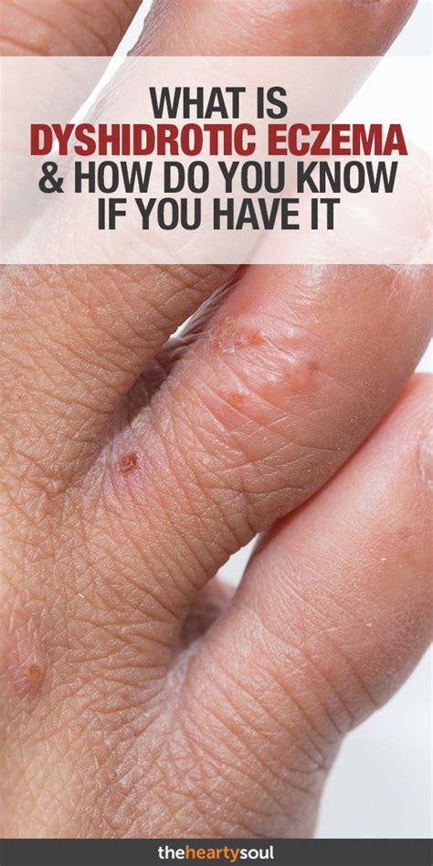 What Is Dyshidrotic Eczema and How Do You Know If You Have It ...