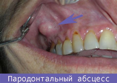 Абсцесс десны: симптомы и лечение