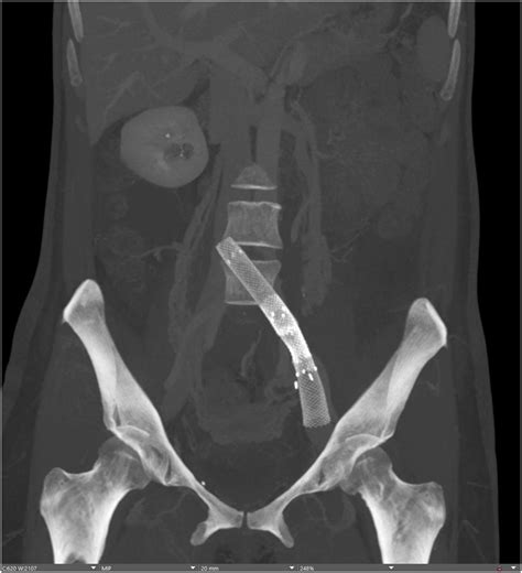 Lumbar Radiculopathy After Left Common Iliac Vein Stenting - Journal of