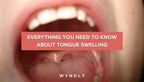 Swollen Tongue: Causes, Symptoms, and Treatment (2024) & Wyndly