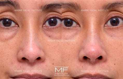 Non Surgical Rhinoplasty Before and After Pictures Case 1109 | San