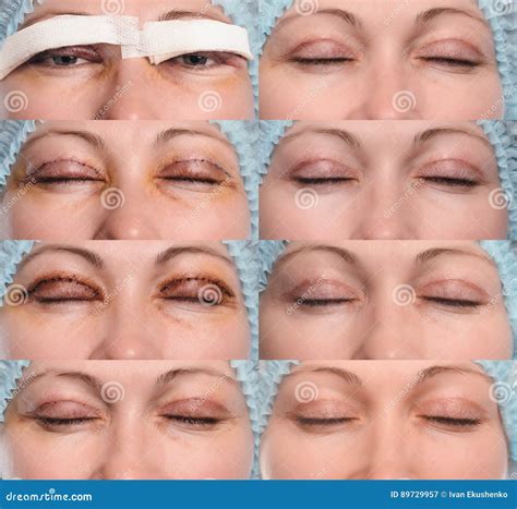Blepharoplasty верхнего века Стоковое Изображение - изображение ...