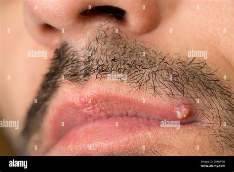 Ingrown hair hi-res stock photography and images - Alamy