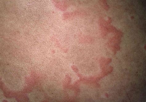 chronic skin rashes  itch jokerperks