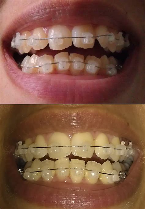 Invisible braces before and after - ferytheatre