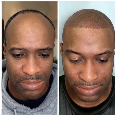 Scalp micro pigmentation will change the way men cut bald 42