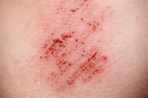 cuts  grazes nhs inform