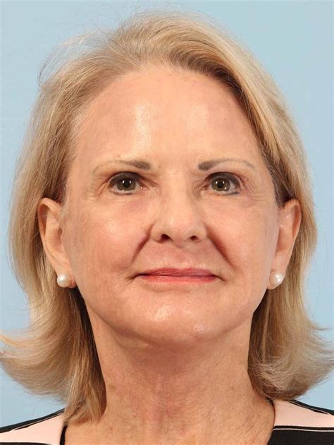 Before & After Face & Neck Lift Bellaire | Face Forward