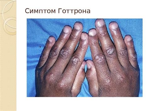 Дерматомиозит Дерматомиозит — диффузное прогрессирующее воспалительное ...