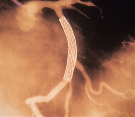 PCI | Cardiac Health