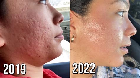 Souirensu It Works: My Before & After Photos Will SHOCK You! - glbkcue