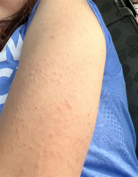 Keratosis Pilaris Treatment Products