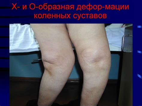 Ревматоидный артрит - презентация онлайн