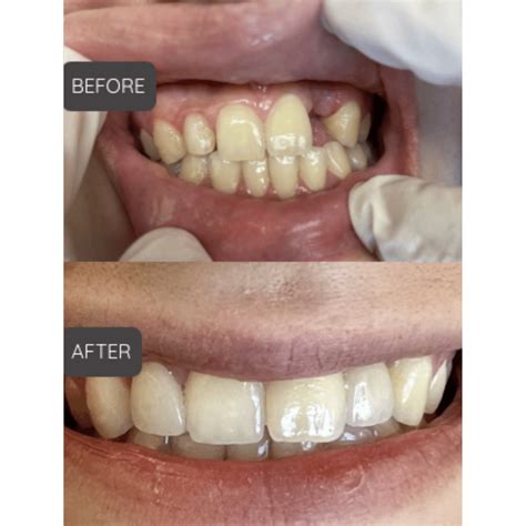 Before and After | Dental Spa of Artesia