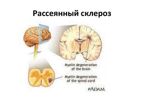 Рассеянный склероз - online presentation