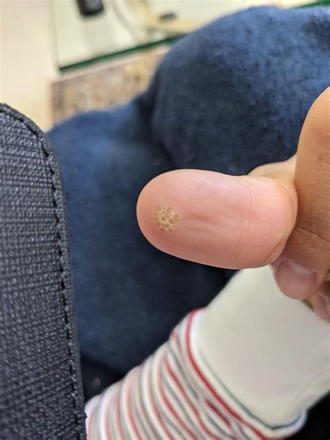 Is my blister okay? : r/medical