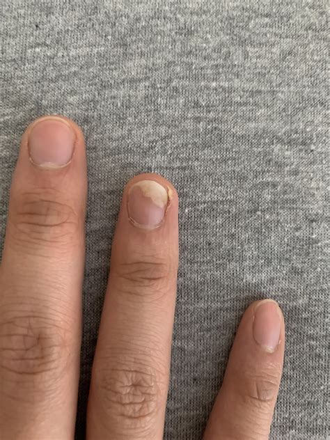 Nail lifting from dodgeball trauma. How should I go about healing
