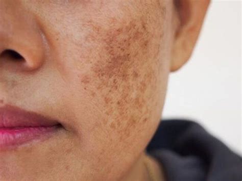 sam da la gi nguyen nhan hinh thanh va cach dieu tri vita clinic