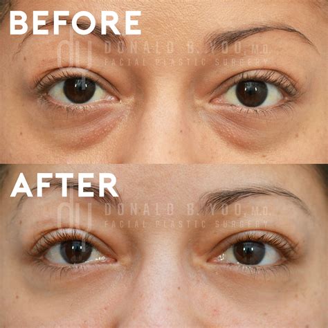 plastic surgery under eye bags 14