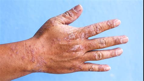 Dry Skin Rash On Hands