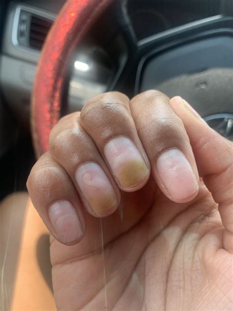 Fingernail Fungus From Acrylic Nails