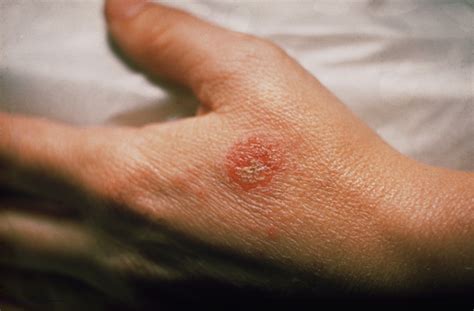 Allergic Eczema - MBBCH Health Encyclopedia