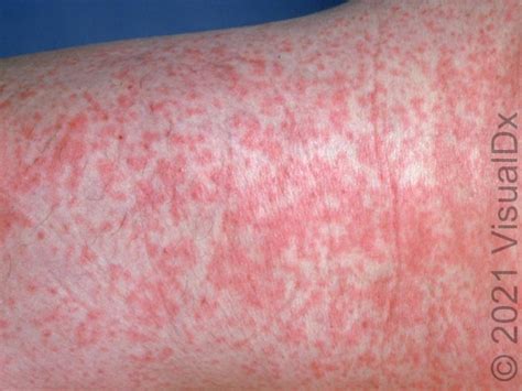 Rubella | VisualDx