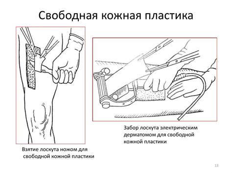 Кожная пластика по Лимбергу - презентация онлайн