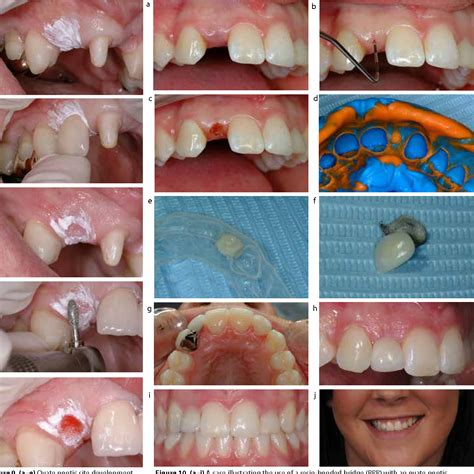 dental bridge pontic  pam calhoun blog