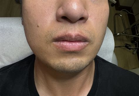 how to remove fordyce spots 2